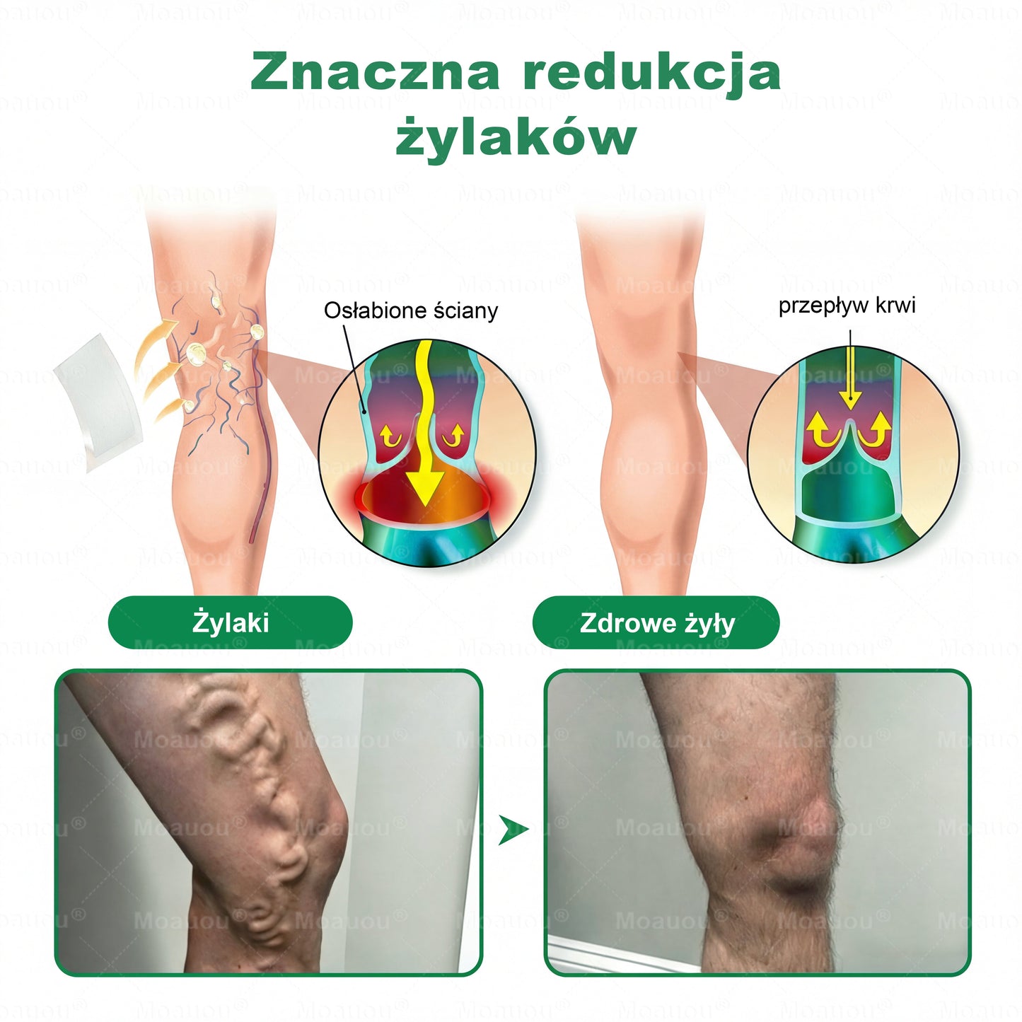Moauou® Mikronakłuwający Plaster ⚡ Natychmiastowa ulga, długotrwałe efekty – WIELKA PROMOCJA!